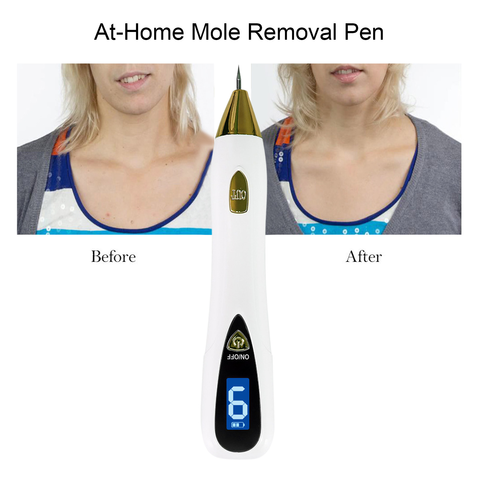 Profesjonalne narzędzie do usu – Plasma Mole Spot Removal Pen 9 Level recenzja i cena